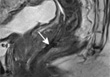 Pictorial essay: Radiological and clinical findings following rectal contact X-ray brachytherapy (Papillon technique) - how to assess response